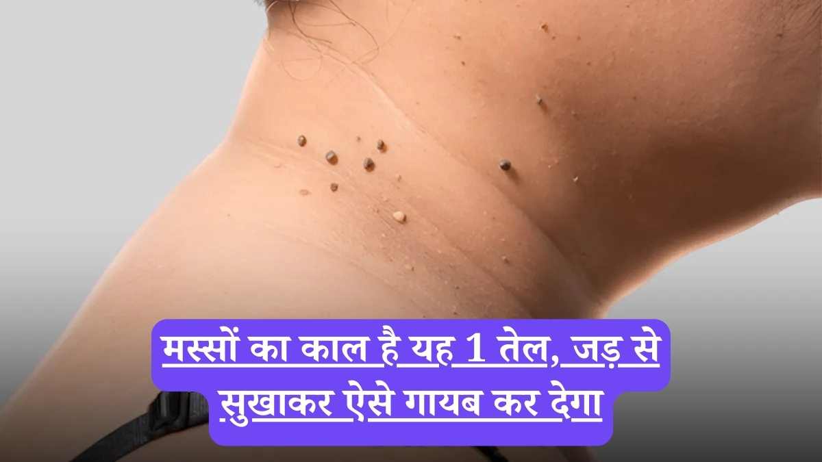 How to remove warts naturally: मस्सों का काल है यह 1 तेल, जड़ से सुखाकर ऐसे गायब कर देगा, जैसे कभी थे ही नहीं
